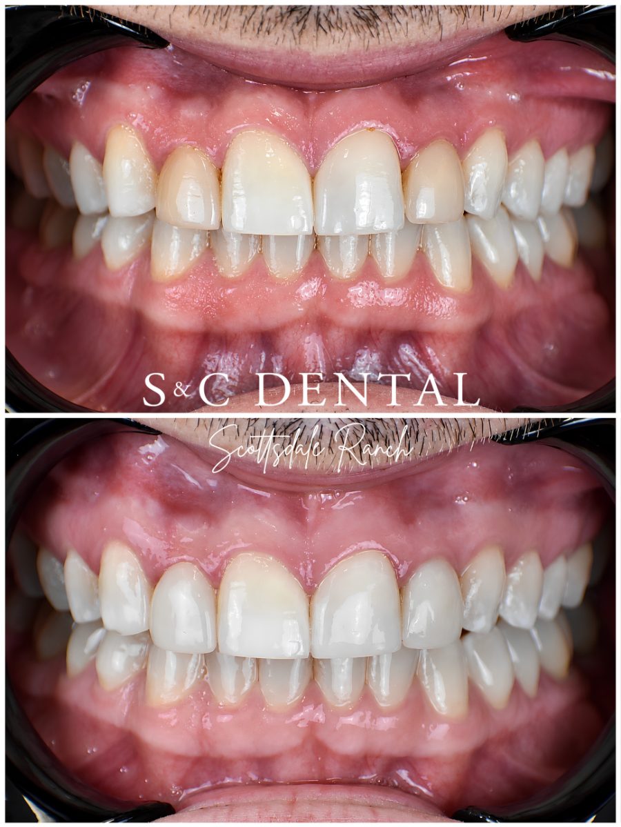 Before and after photo of a patient’s smile treated at S&C Dental Scottsdale Ranch in Scottsdale, AZ - case 1