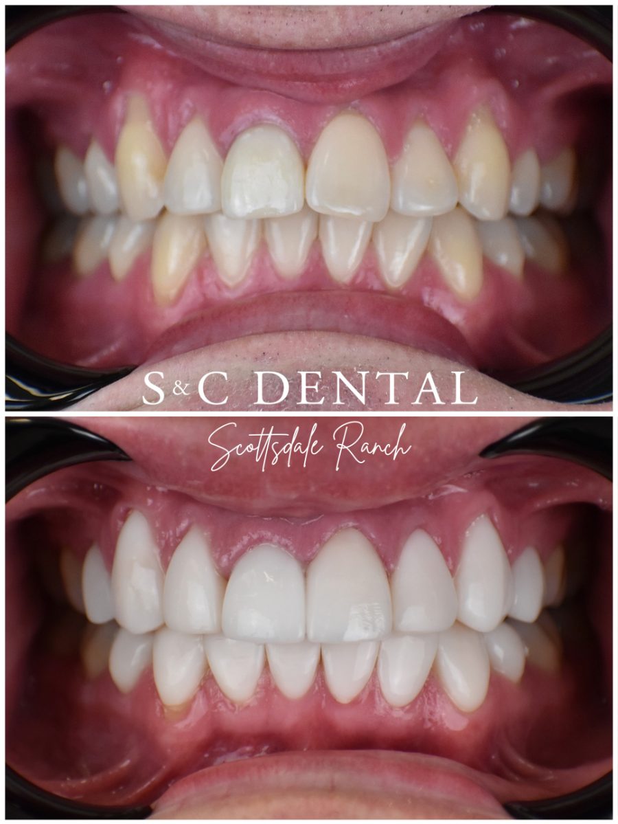 Before and after photo of a patient’s smile treated at S&C Dental Scottsdale Ranch in Scottsdale, AZ - case 2