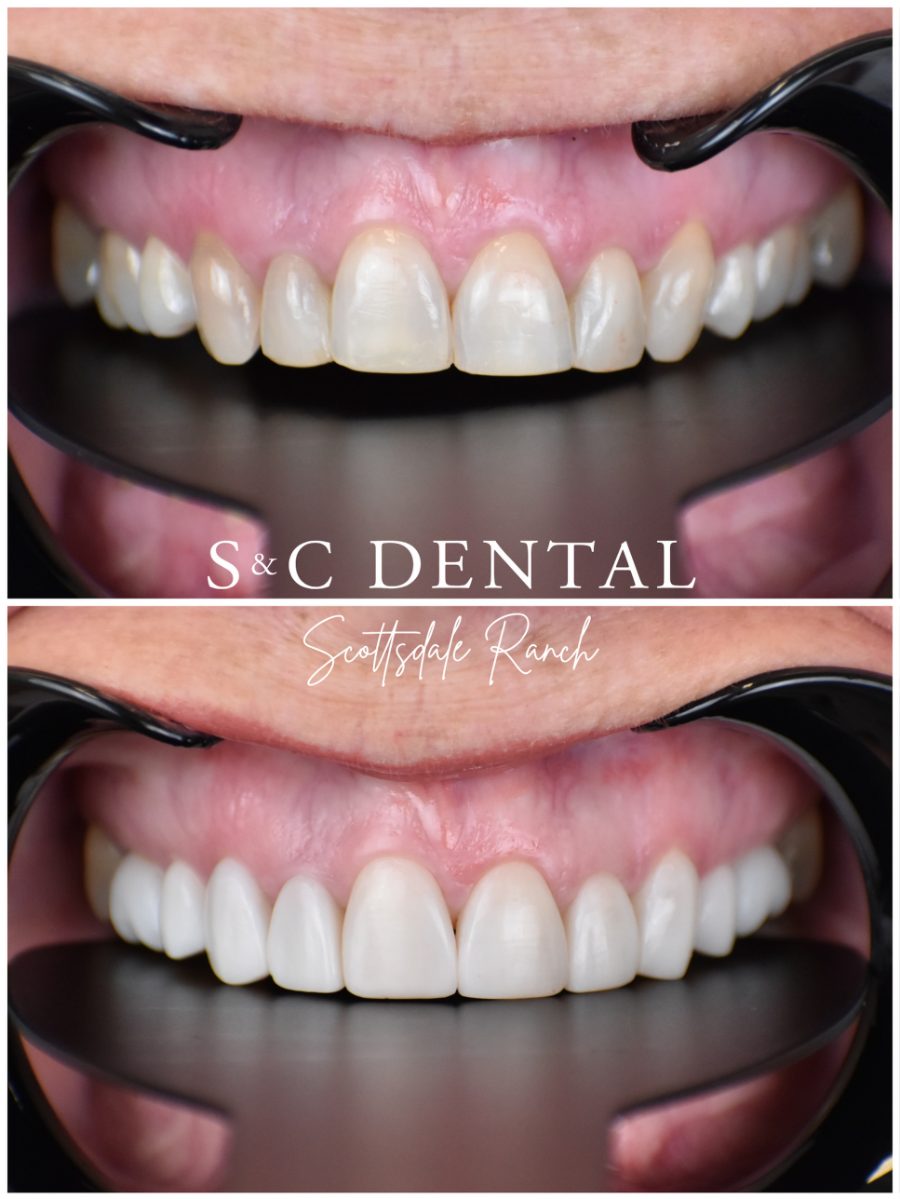 Before and after photo of a patient’s smile treated at S&C Dental Scottsdale Ranch in Scottsdale, AZ - case 3