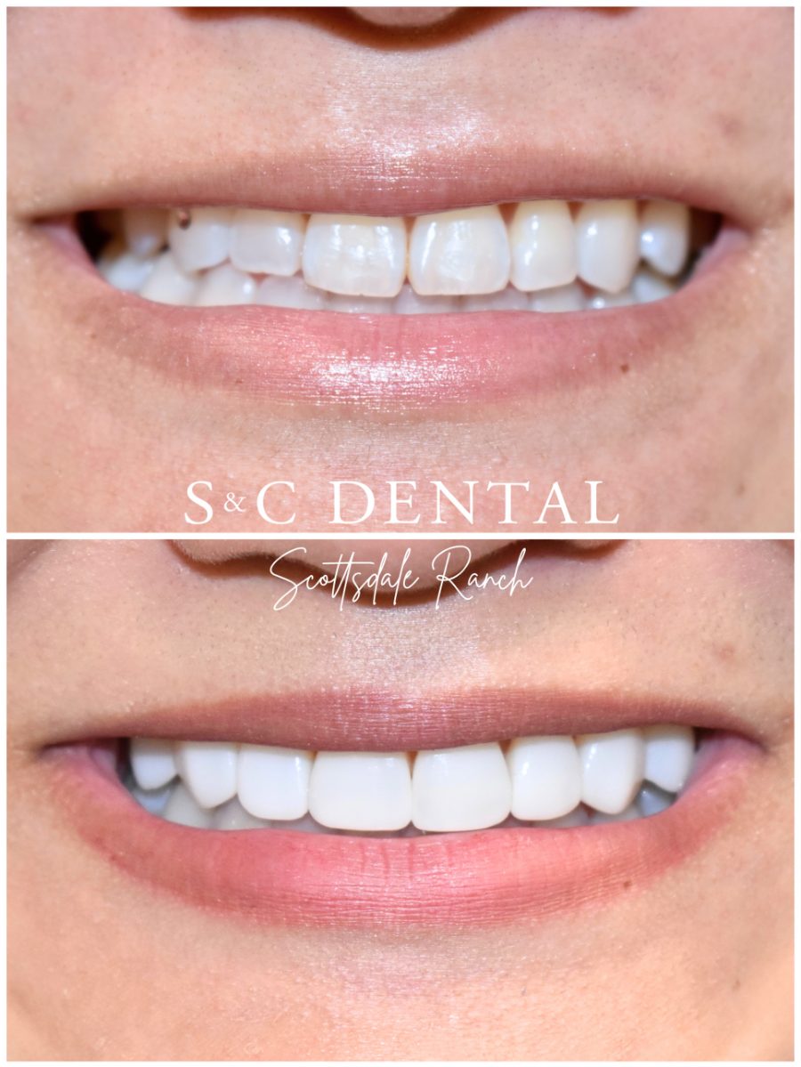 Before and after photo of a patient’s smile treated at S&C Dental Scottsdale Ranch in Scottsdale, AZ - case 4