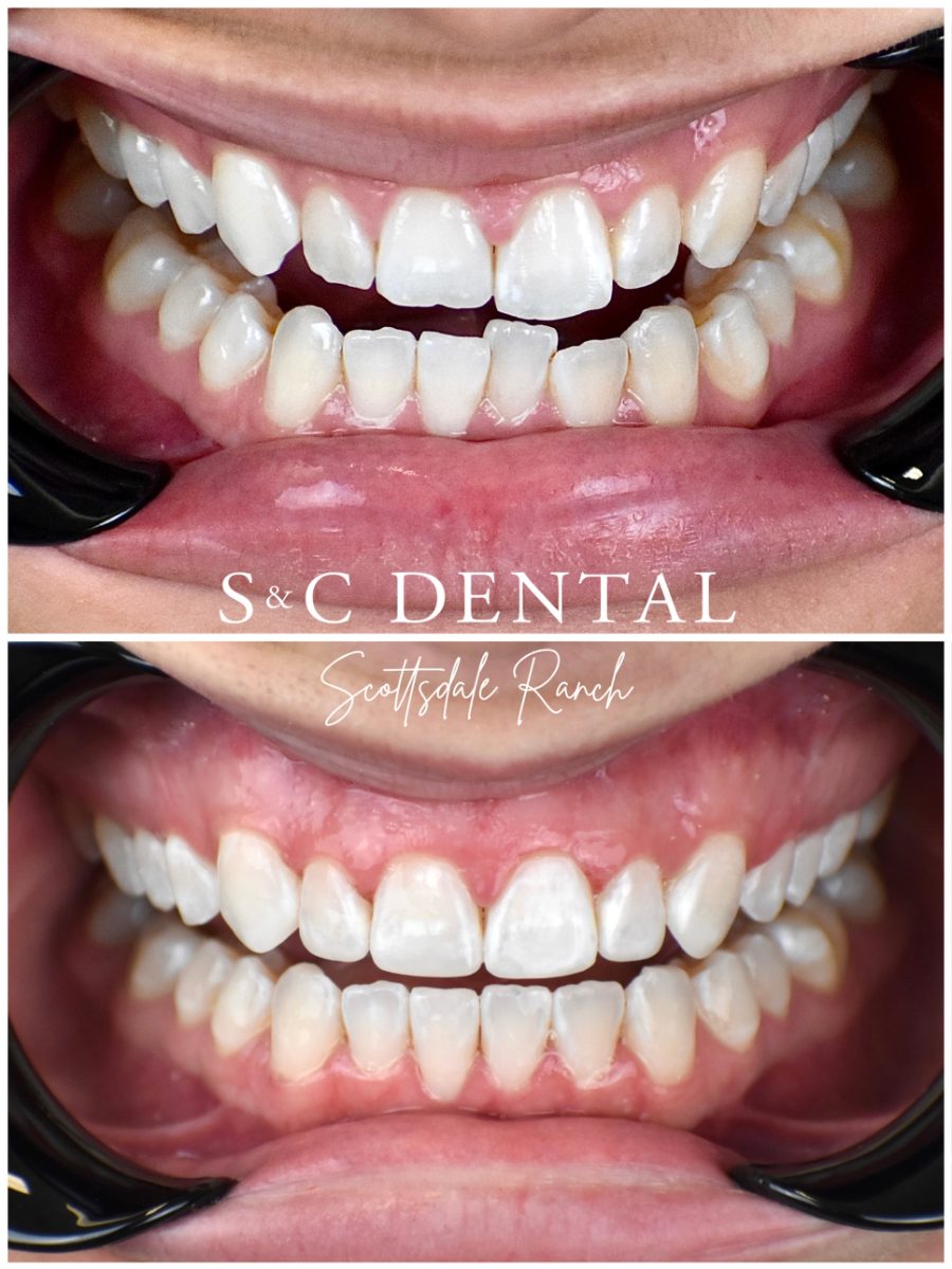 Before and after photo of a patient’s smile treated at S&C Dental Scottsdale Ranch in Scottsdale, AZ - case 5