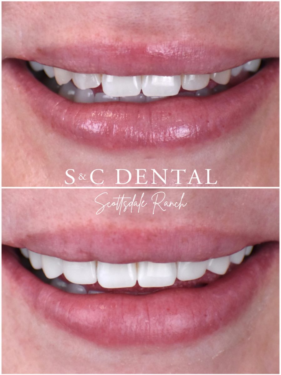 Before and after photo of a patient’s smile treated at S&C Dental Scottsdale Ranch in Scottsdale, AZ - case 6