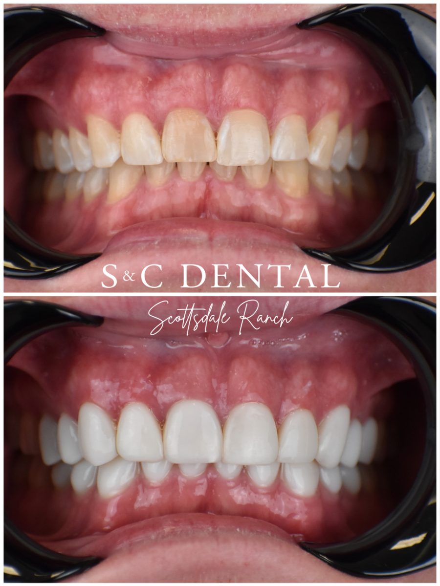 Before and after photo of a patient’s smile treated at S&C Dental Scottsdale Ranch in Scottsdale, AZ - case 7