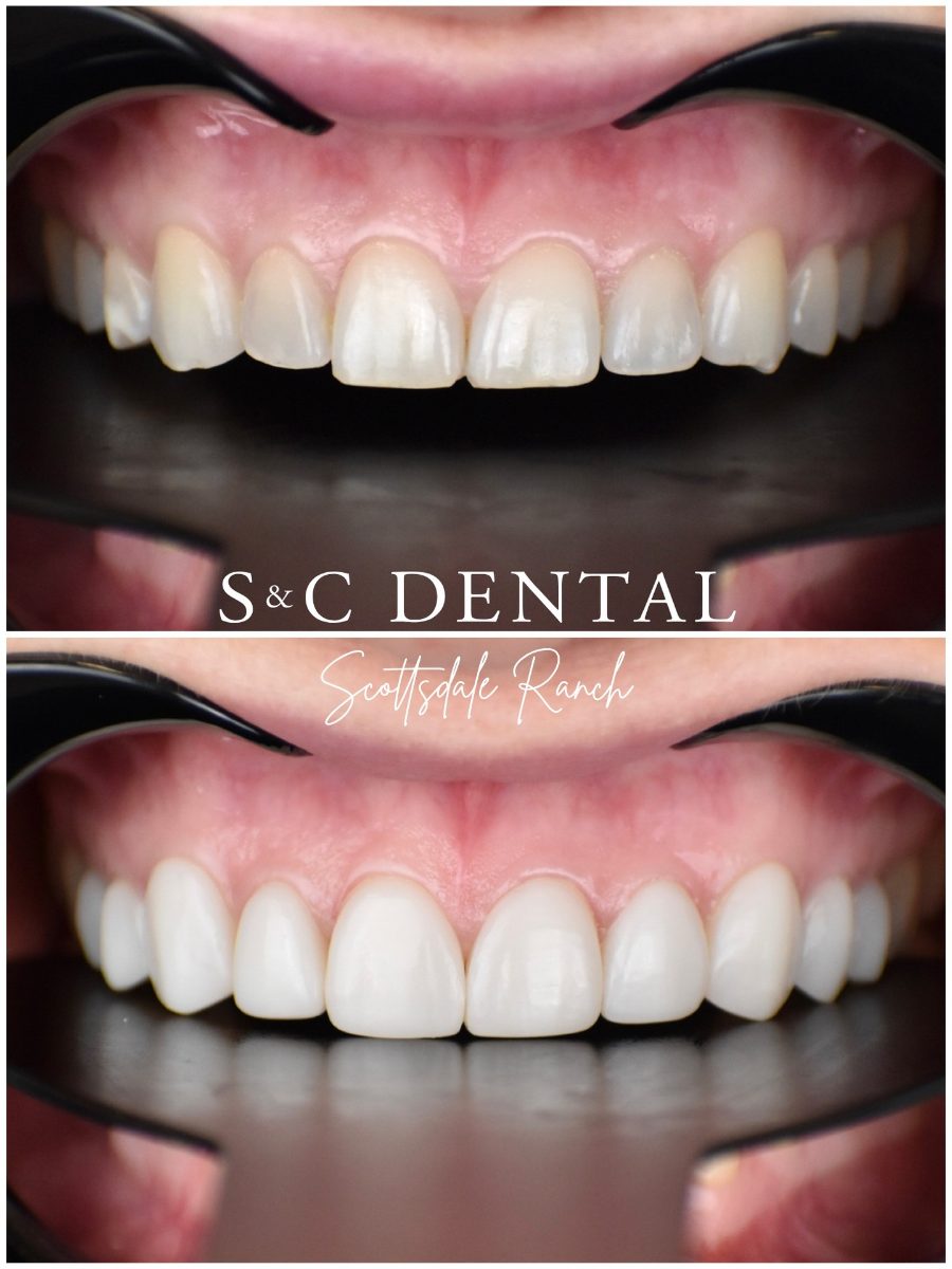 Before and after photo of a patient’s smile treated at S&C Dental Scottsdale Ranch in Scottsdale, AZ - case 10
