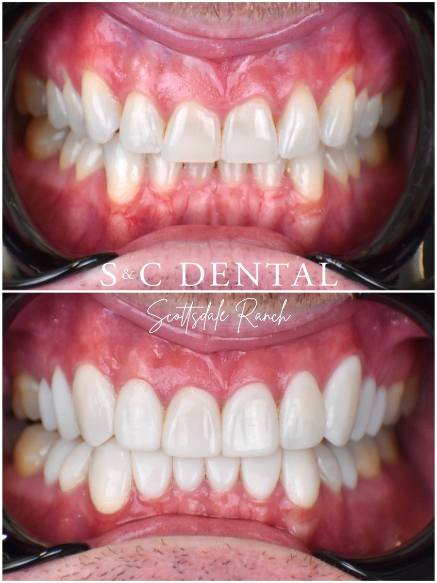 Before and after photo of a patient’s smile treated at S&C Dental Scottsdale Ranch in Scottsdale, AZ - case 11