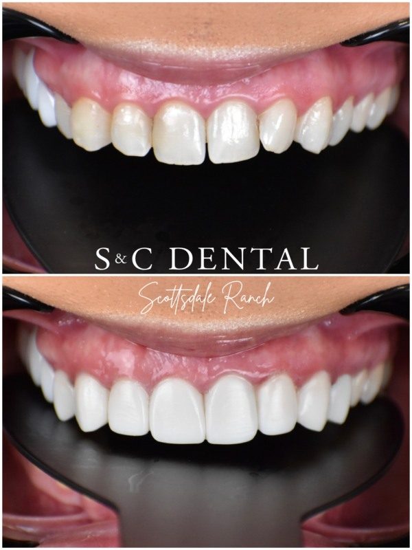 Before and after photo of a patient’s smile treated at S&C Dental Scottsdale Ranch in Scottsdale, AZ - case 12