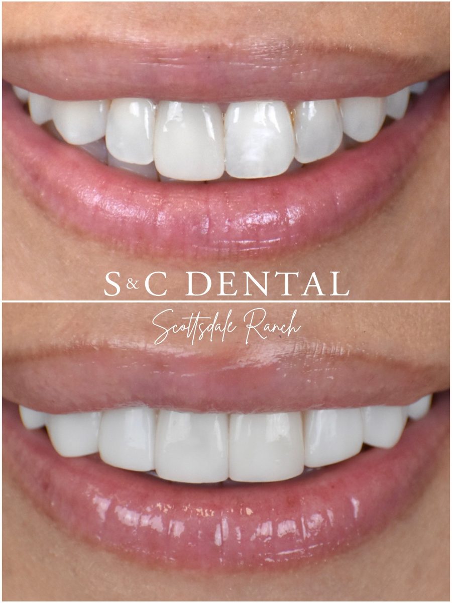 Before and after photo of a patient’s smile treated at S&C Dental Scottsdale Ranch in Scottsdale, AZ - case 14