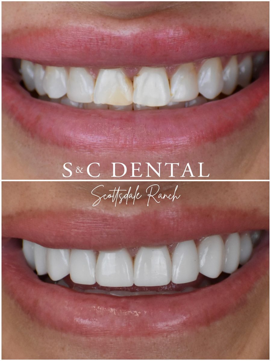 Before and after photo of a patient’s smile treated at S&C Dental Scottsdale Ranch in Scottsdale, AZ - case 16